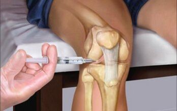 intra-articular injection into the joint for arthrosis