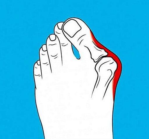 toe joint arthrosis
