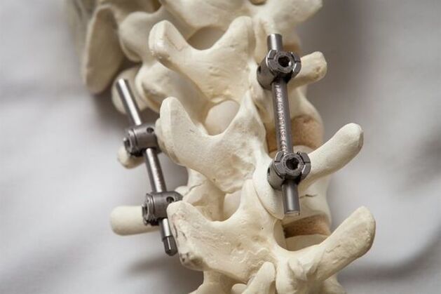 fixation of osteochondrosis of the neck spine