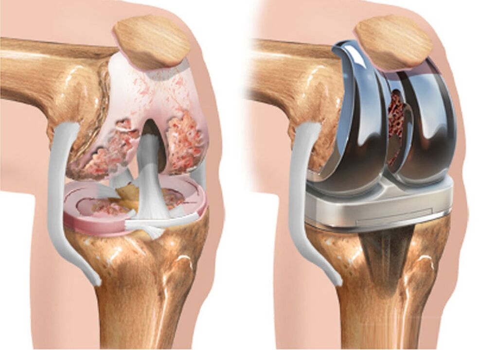 before and after arthrosis of the knee joint for arthrosis