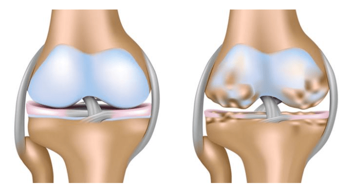 healthy cartilage and knee joint damage with osteoarthritis
