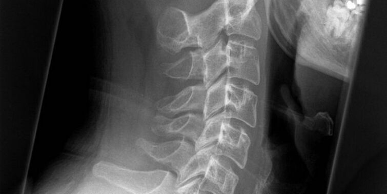 A photo of the cervical region