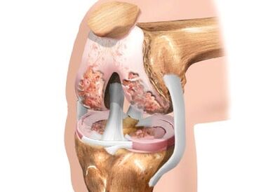 Damage to knee articulation arthrosis